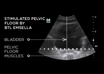 An ultrasound of a Stimulated Pelvic floor by BTL Emsella treatment | APEX Performance & Aesthetics in Sandy, UT