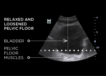 An ultrasound of a relaxed Pelvic floor by BTL Emsella treatment | APEX Performance & Aesthetics in Sandy, UT