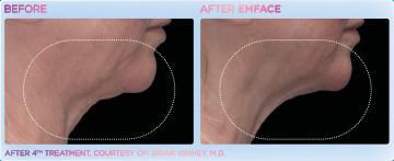 Women Neck with Em Face before and after Treatment | APEX Performance & Aesthetics in Sandy, UT