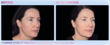 Women with Em Face before and after Treatment | APEX Performance & Aesthetics in Sandy, UT