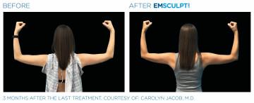 Women with Em Scupt before and after Treatment | APEX Performance & Aesthetics in Sandy, UT