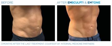 Men with Em Scupt and Emtone before and after Treatment | APEX Performance & Aesthetics in Sandy, UT