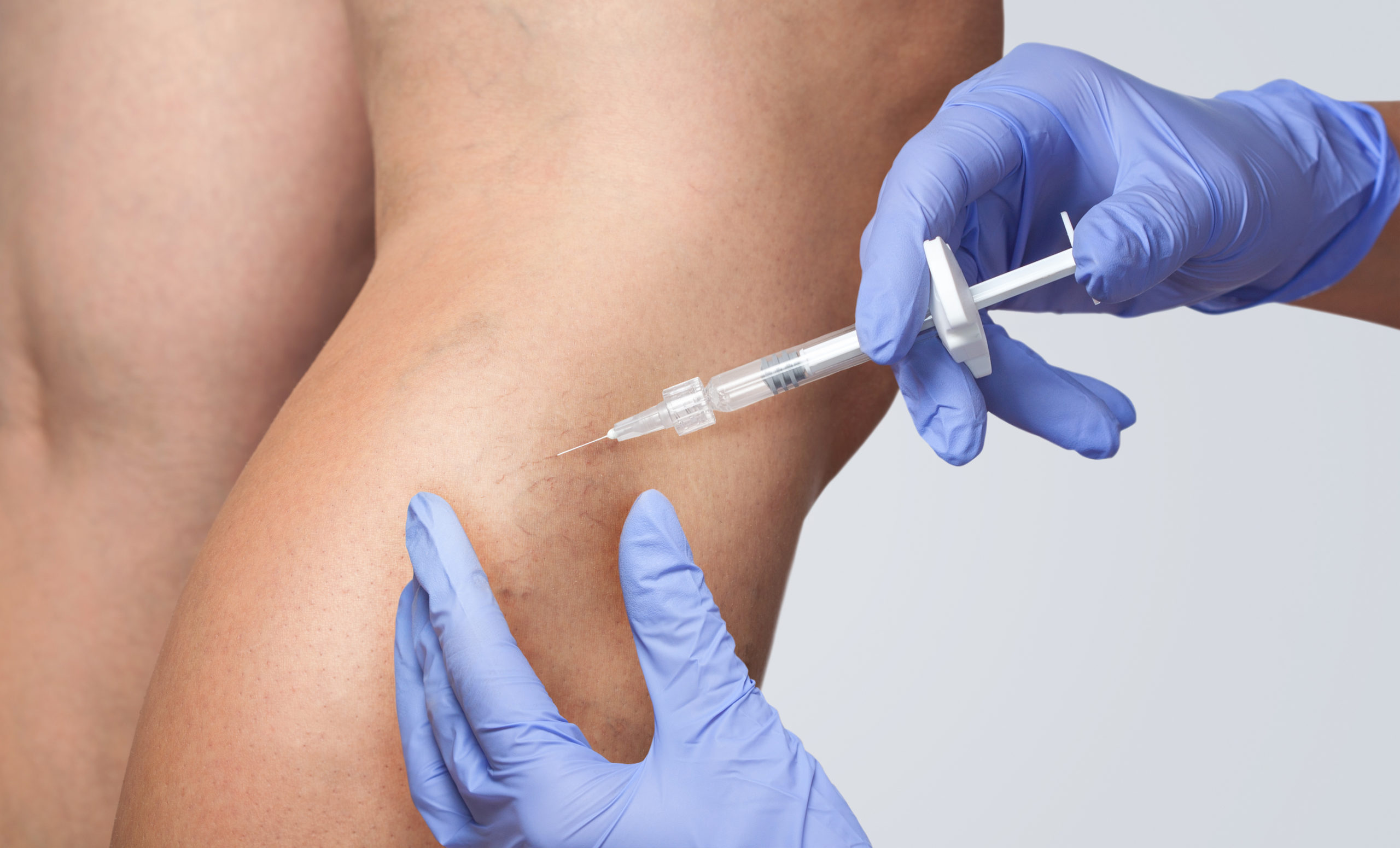 A doctor does medical procedure Sclerotherapy used to eliminate varicose veins and spider veins. An injection of a solution directly into the vein | APEX Performance & Aesthetics in Sandy, UT