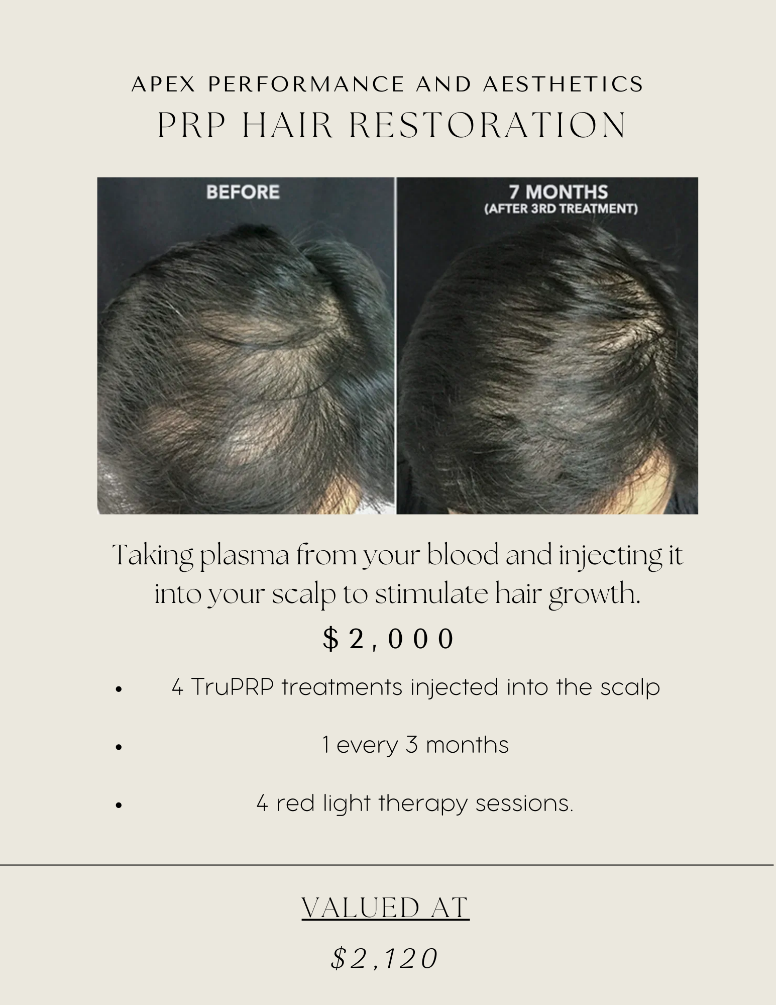 PRP Hair Restoration - Package | APEX Performance & Aesthetics in Sandy, UT
