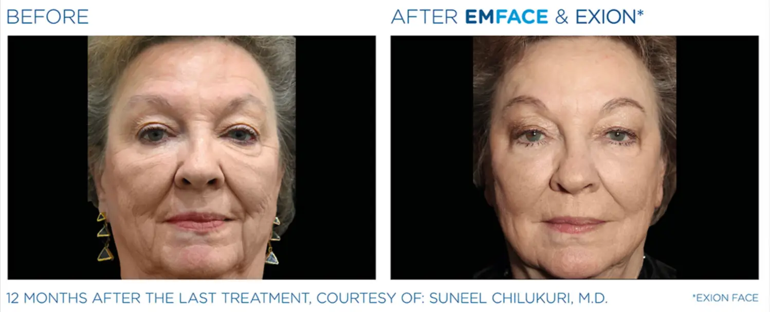 Exion Face 8 Emface_Exion_PIC_Ba-card-face-female-001_ENUS100-png-Shared-Adobe-cloud-storage