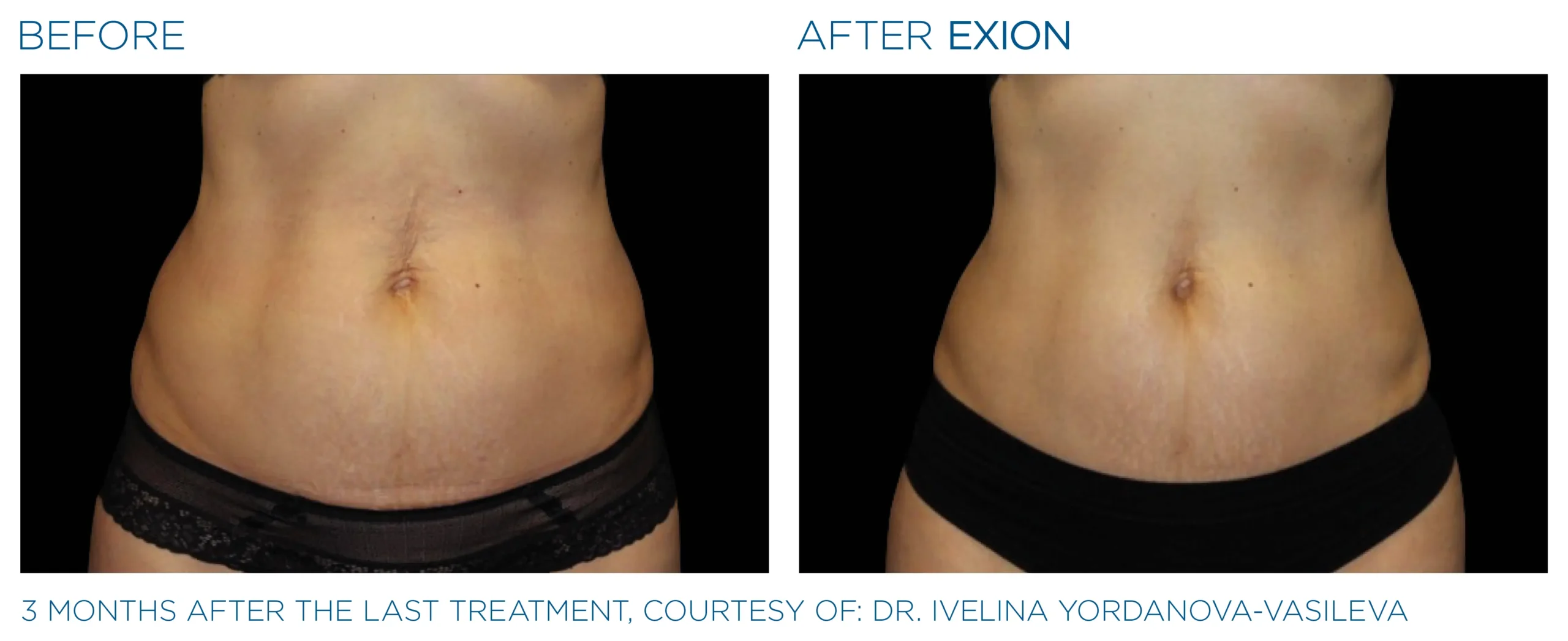 Exion Body Applicator 8 Exion_PIC_Ba-card-abdomen-female-050_Body_ENUS100