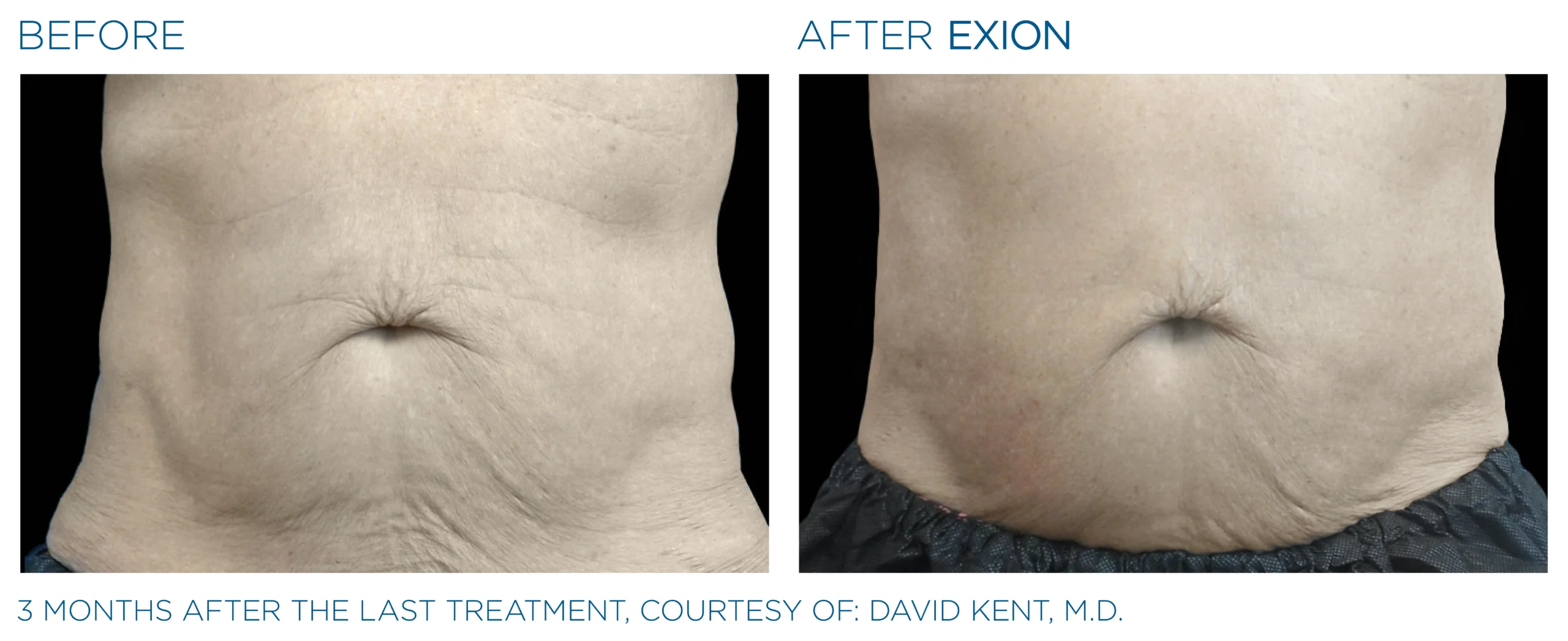 Exion Body Applicator 7 Exion_PIC_Ba-card-abdomen-male-019_Body_ENUS100