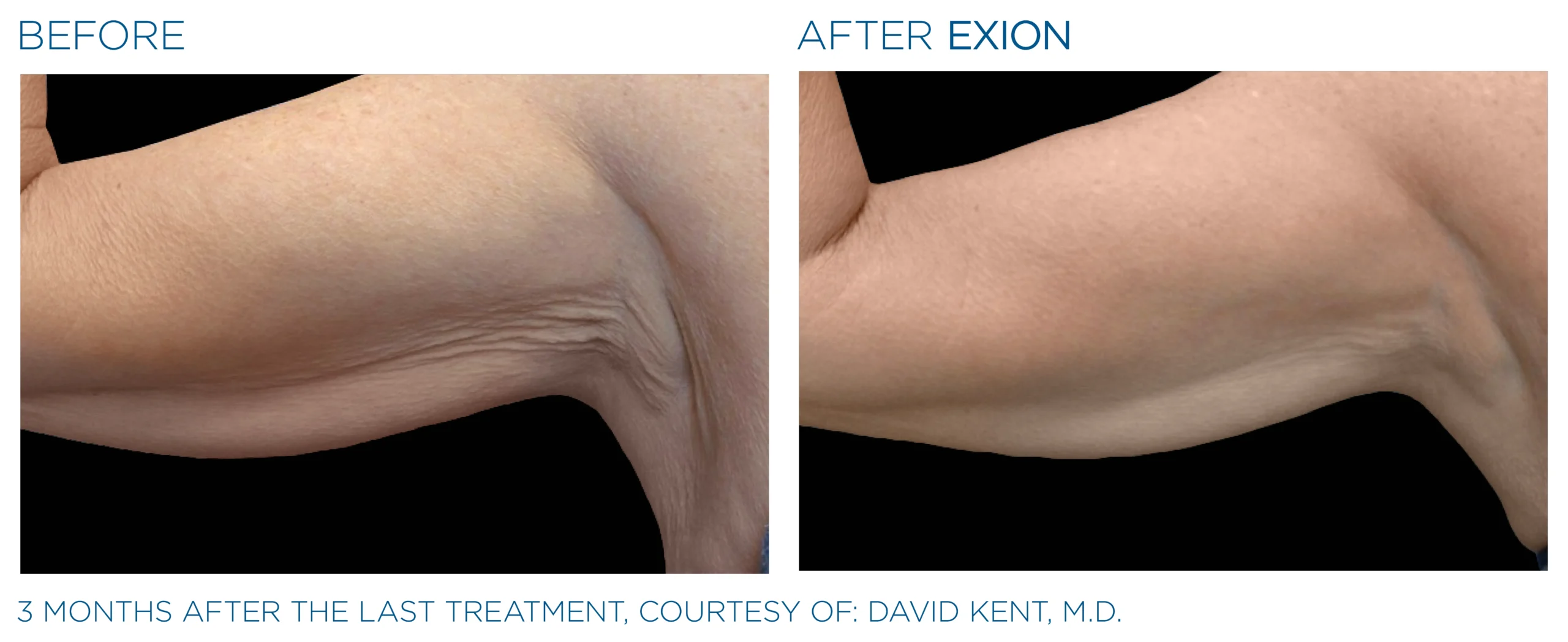 Exion Body Applicator 5 Exion_PIC_Ba-card-arms-female-042_Body_ENUS100