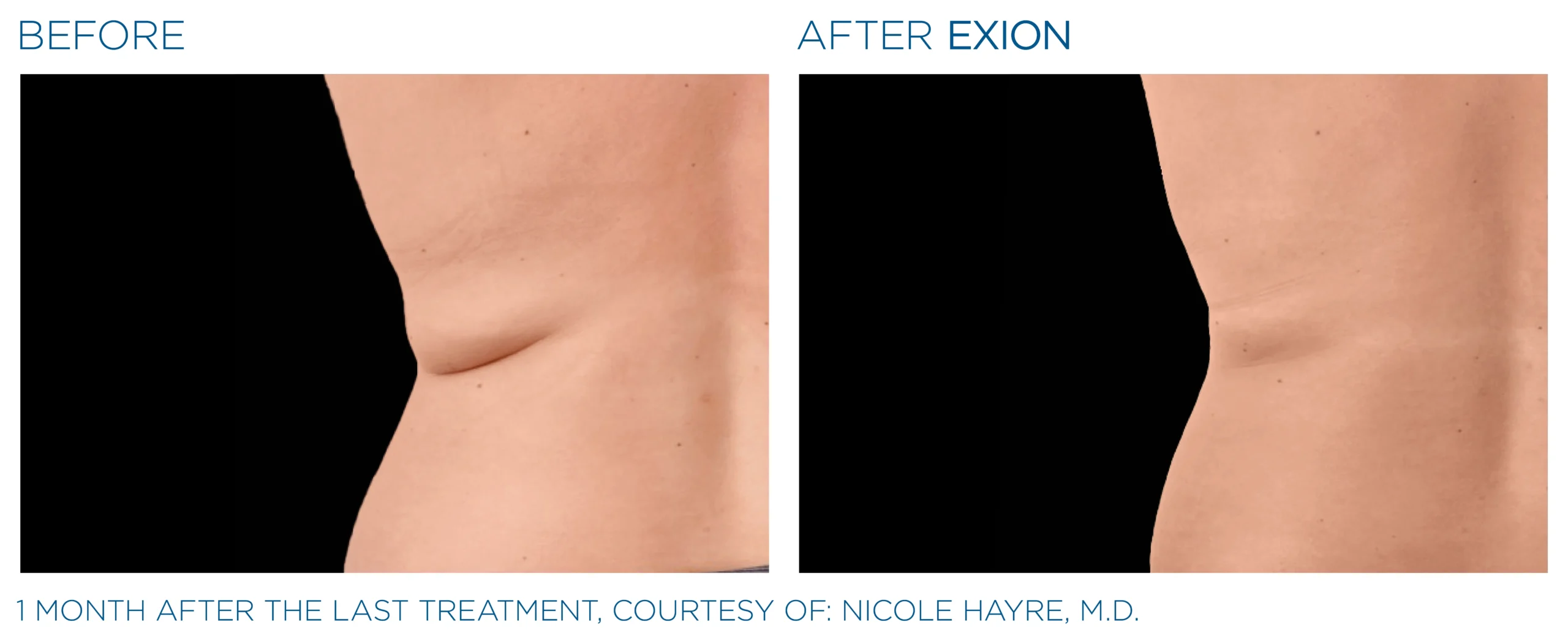 Exion Body Applicator 3 Exion_PIC_Ba-card-back-female-012_Body_ENUS100