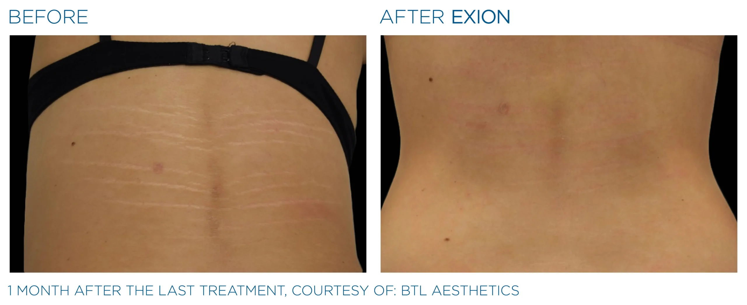 Exion Body Applicator 2 Exion_PIC_Ba-card-back-female-024_FRF_ENUS100