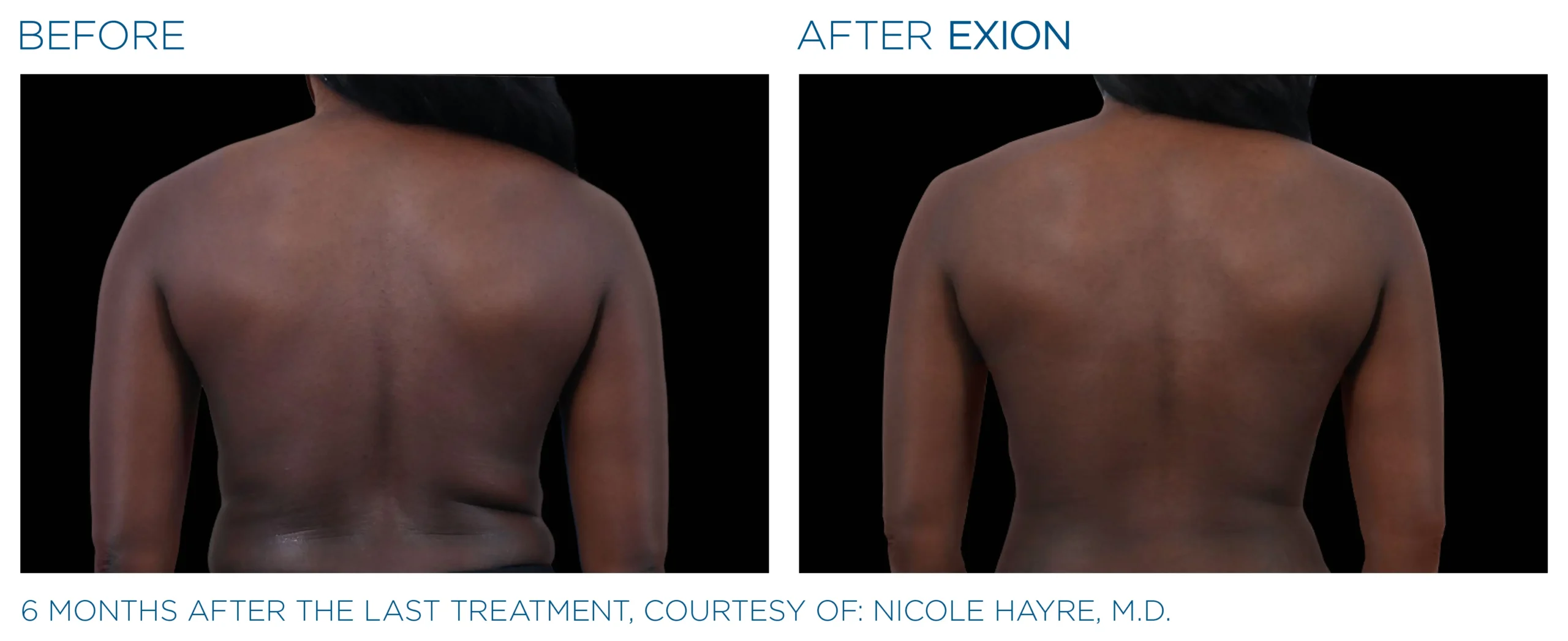 Exion Body Applicator 4 Exion_PIC_Ba-card-back-female-037_Body_ENUS100