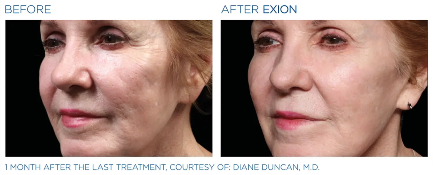 Exion Face 7 Exion_PIC_Ba-card-cheek-female-004_FRF_ENUS100-1-png-Shared-Adobe-cloud-storage
