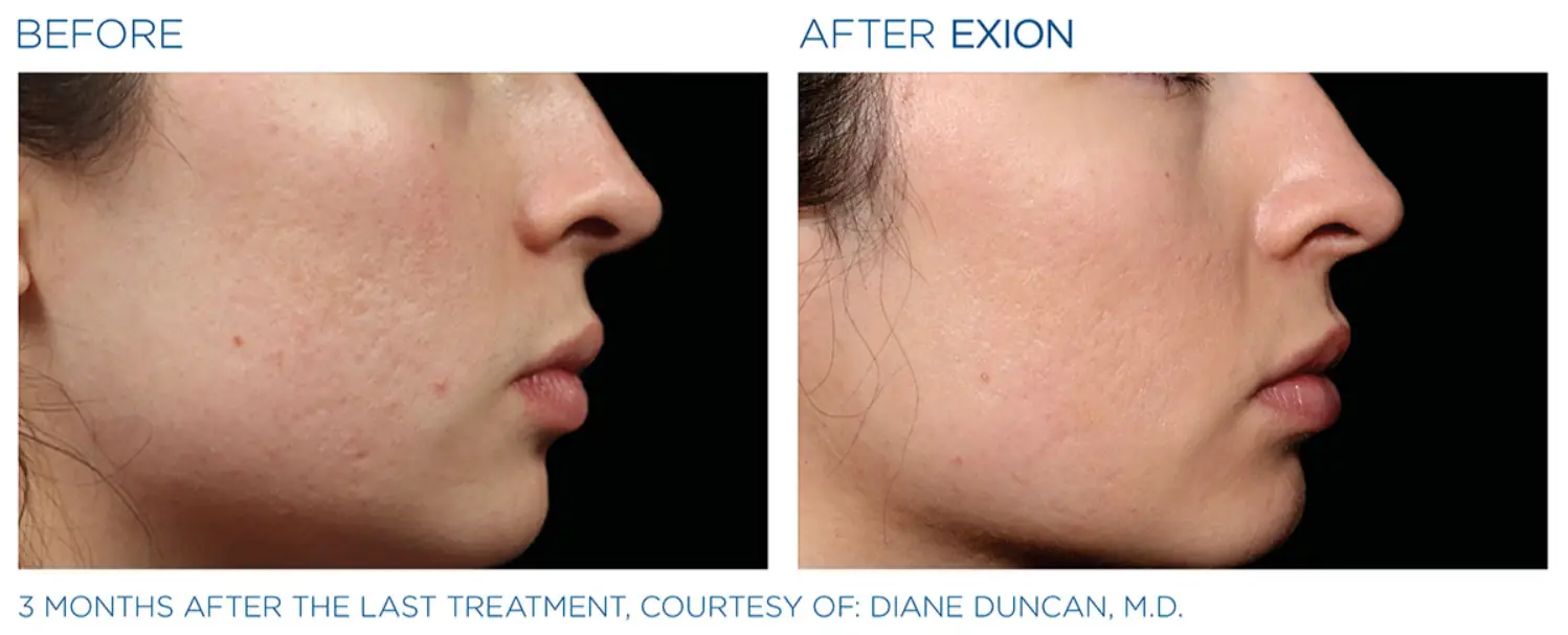 Exion Face 6 Exion_PIC_Ba-card-cheek-female-040_FRF