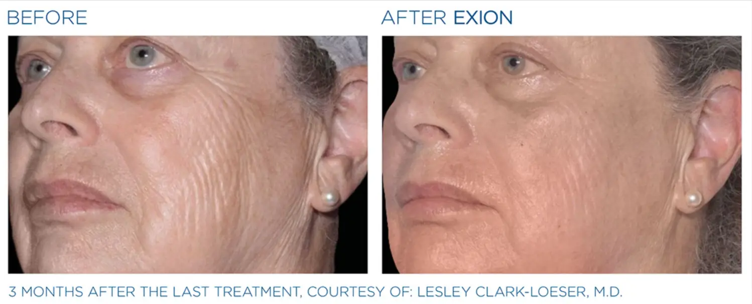 Exion Face 5 Exion_PIC_Ba-card-cheek-female-061_FRF
