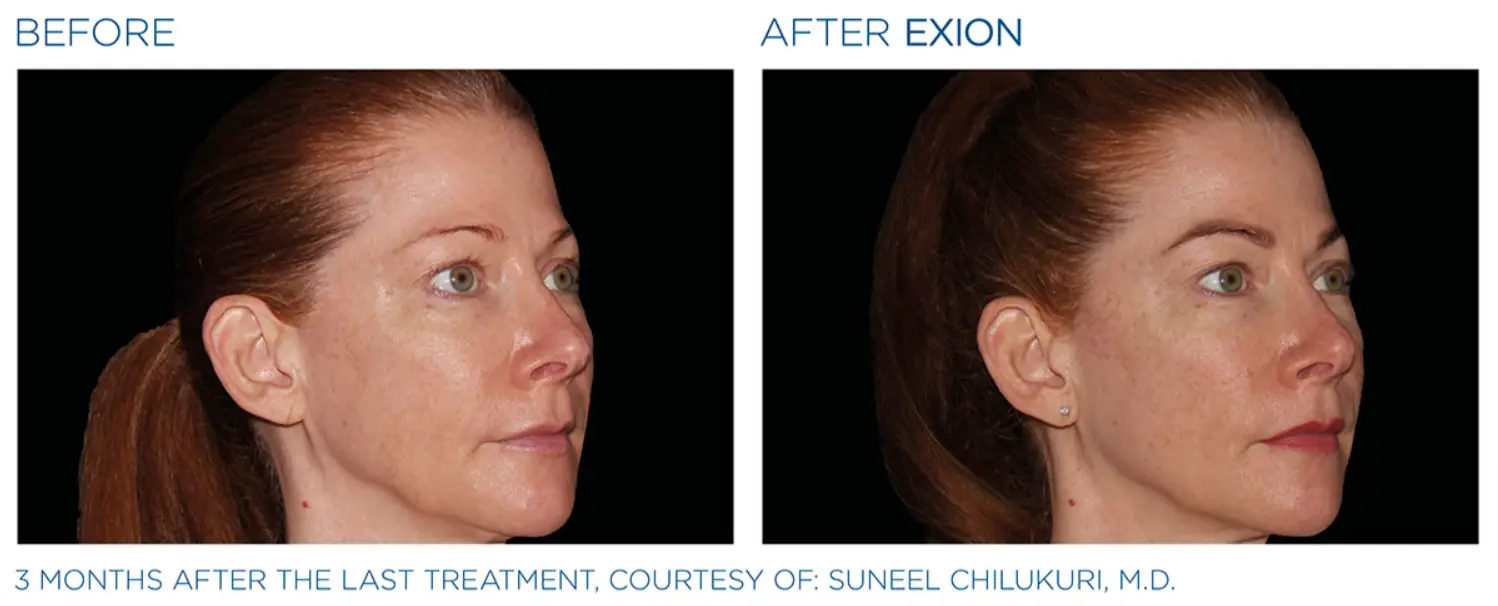 Exion Face 3 Exion_PIC_Ba-card-face-female-030