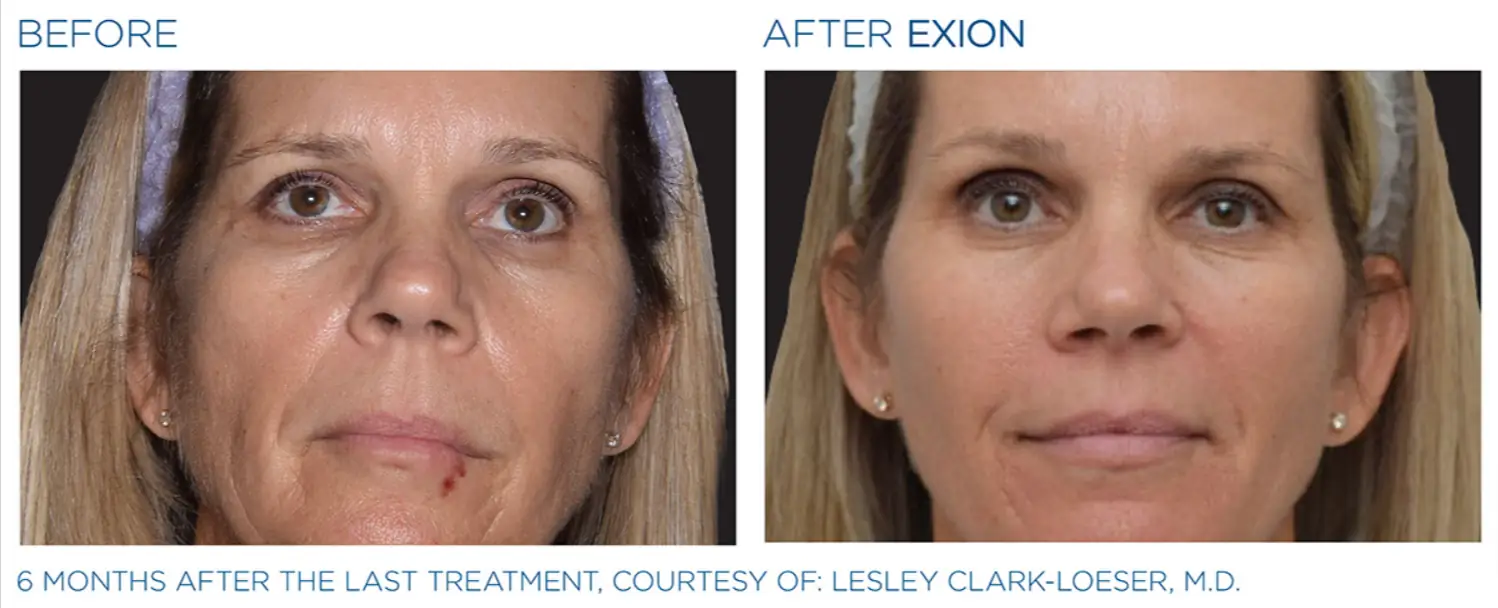 Exion Face 2 Exion_PIC_Ba-card-face-female-068