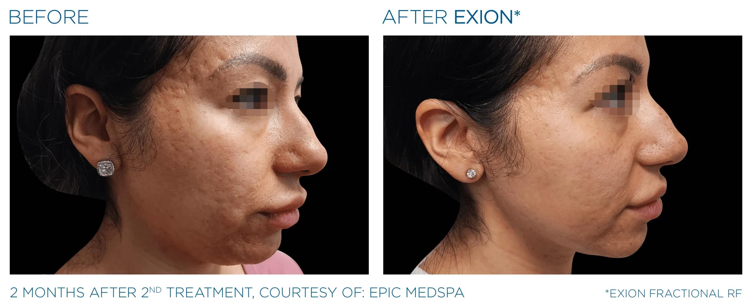 Exion_PIC_Ba-card-face-female-071_FRF_ENUS100 (1)-min