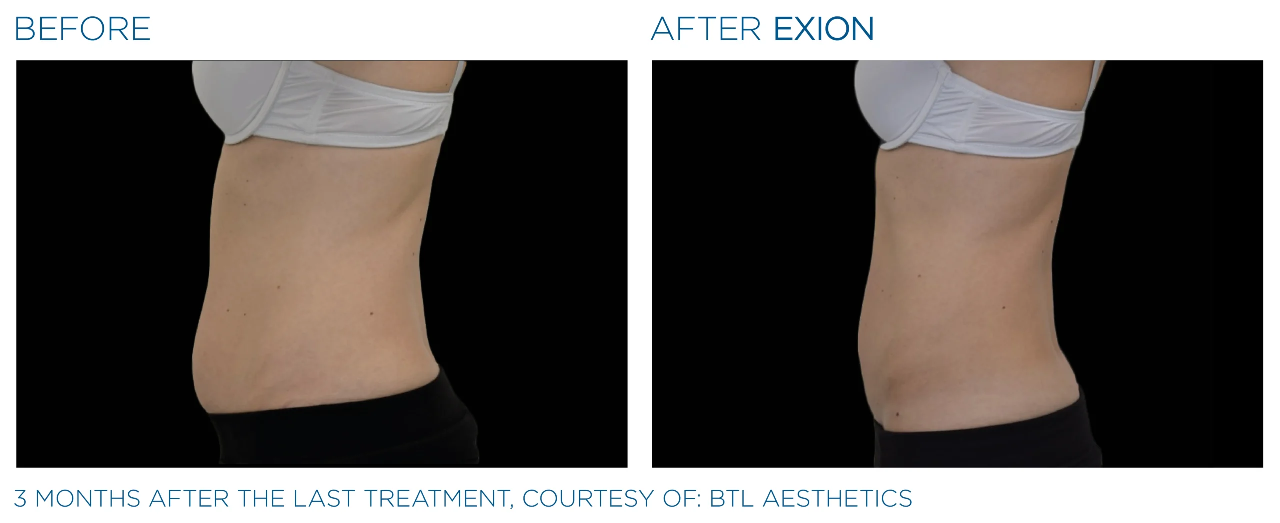 Exion Body Applicator 6 Exion_PIC_Ba-card-lateral abdomen-female-034_Body_ENUS100
