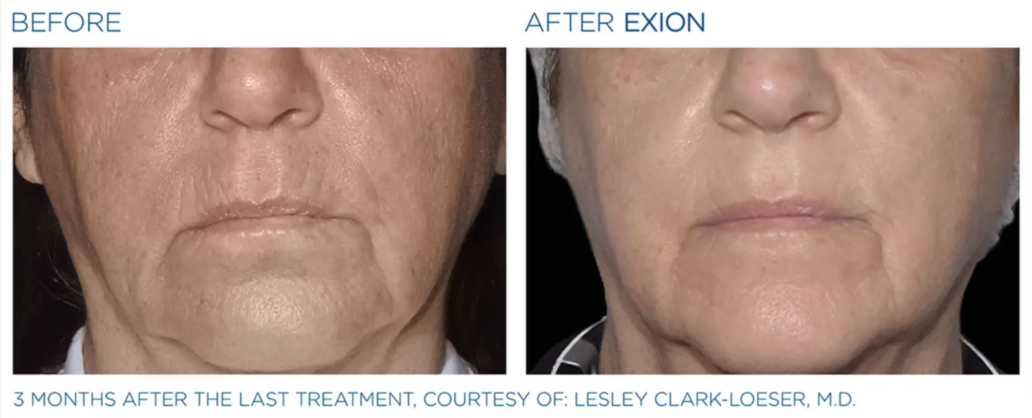 Exion Face 4 Exion_PIC_Ba-card-mouth-female-060_Face_ENUS100-png-Shared-Adobe-cloud-storage